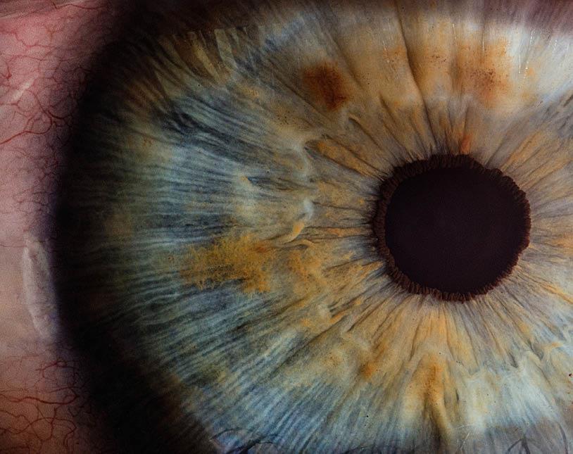 causas ojos rojos erosion corneal ojo seco