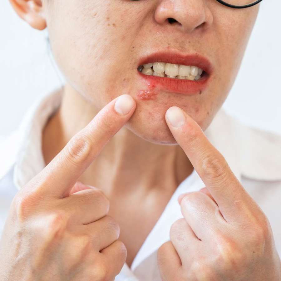 10 remedios caseros para curar un herpes labial rápido